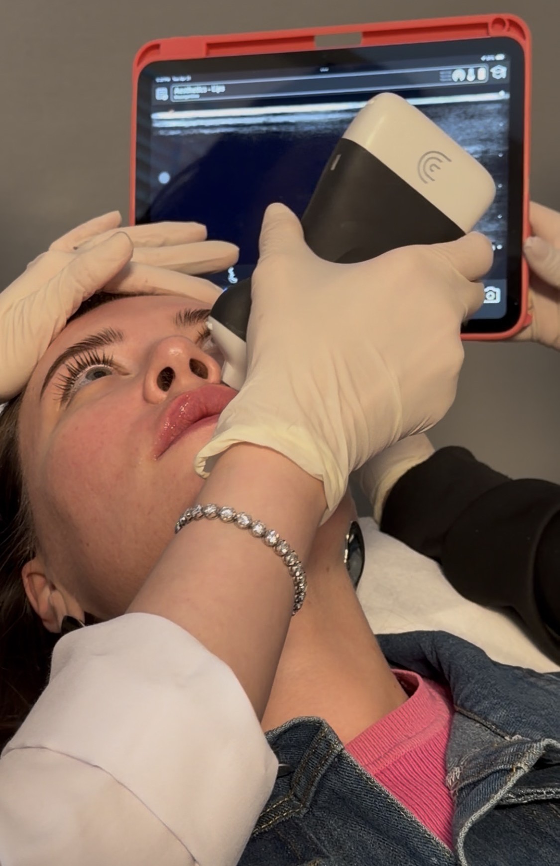Endolift Laser Under Ultrasonography Guidance