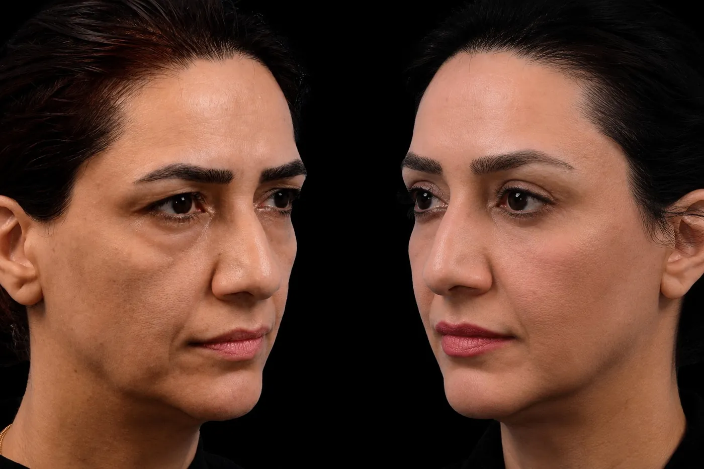 Lower Eyelid Surgery