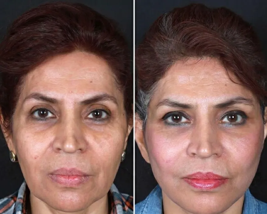 Deep Plane Face Lift