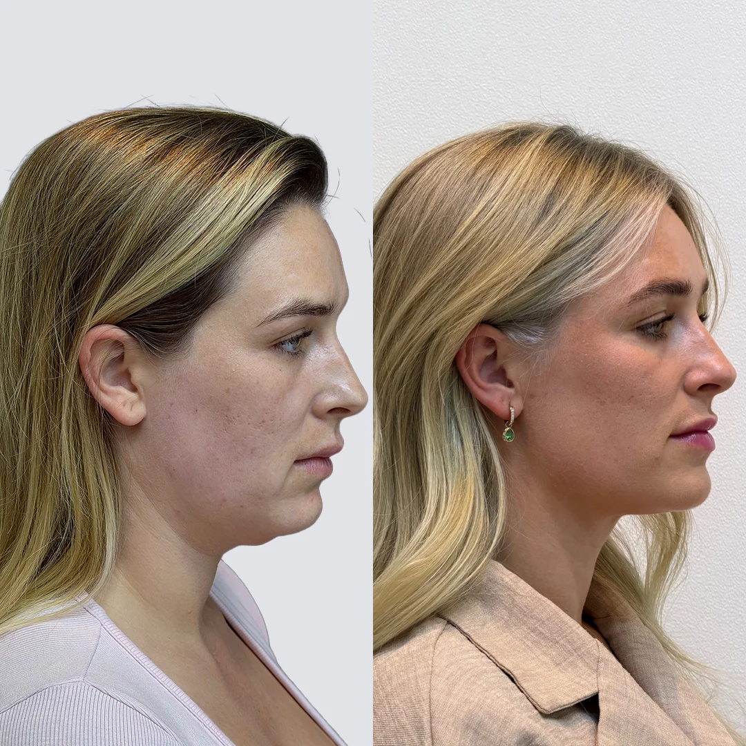 Can Endolift Fix Under-Eye Bags & Hollow Cheeks?