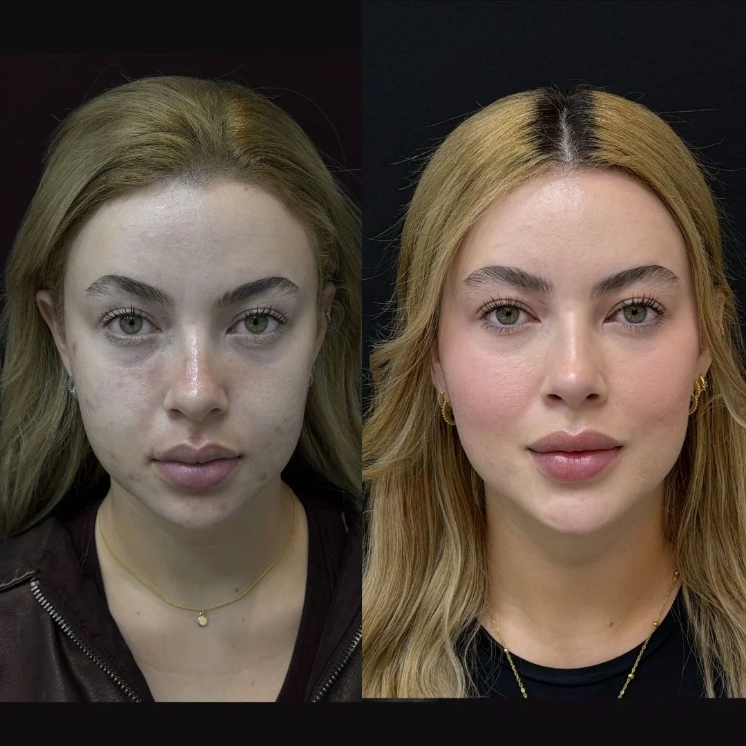 Full Face Fat Transfer: Your Face, Rebooted