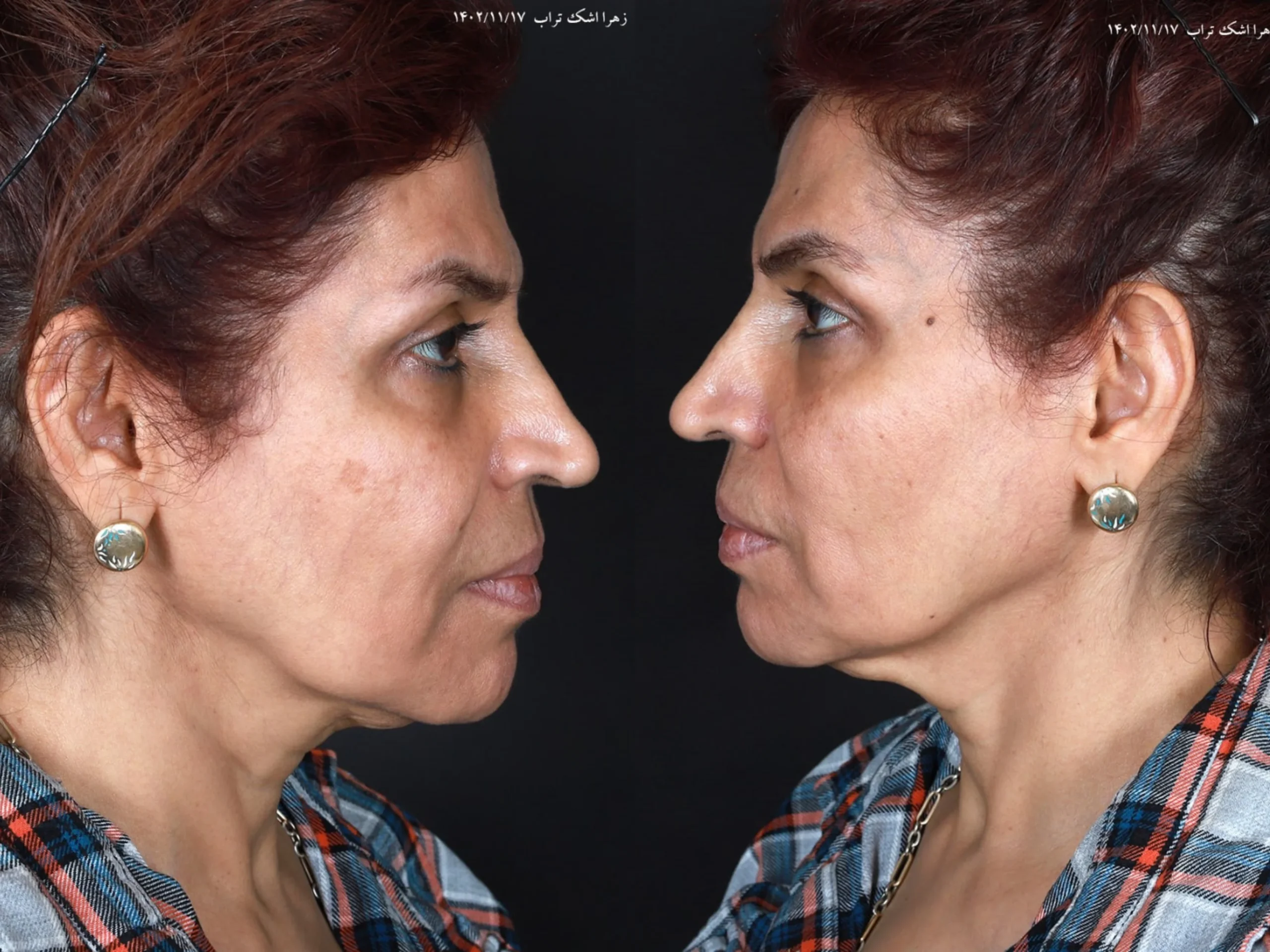 Deep Plane Facelift Treatment for Long-Lasting Results