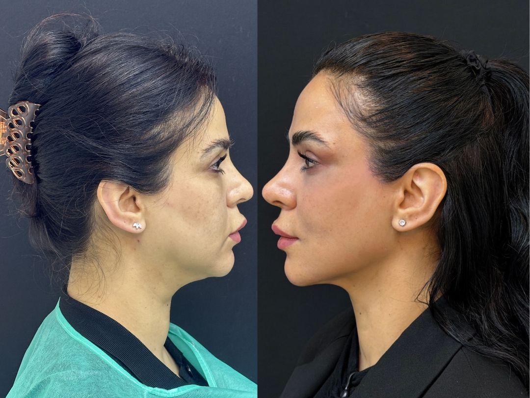 How Endolift Laser Treatment Works for Skin Tightening and Lifting