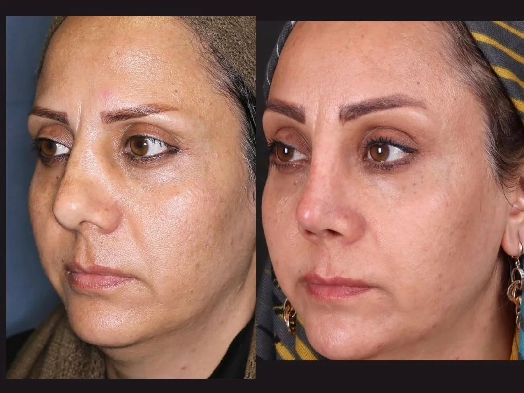 Common Rhinoplasty Mistakes and How to Avoid Them