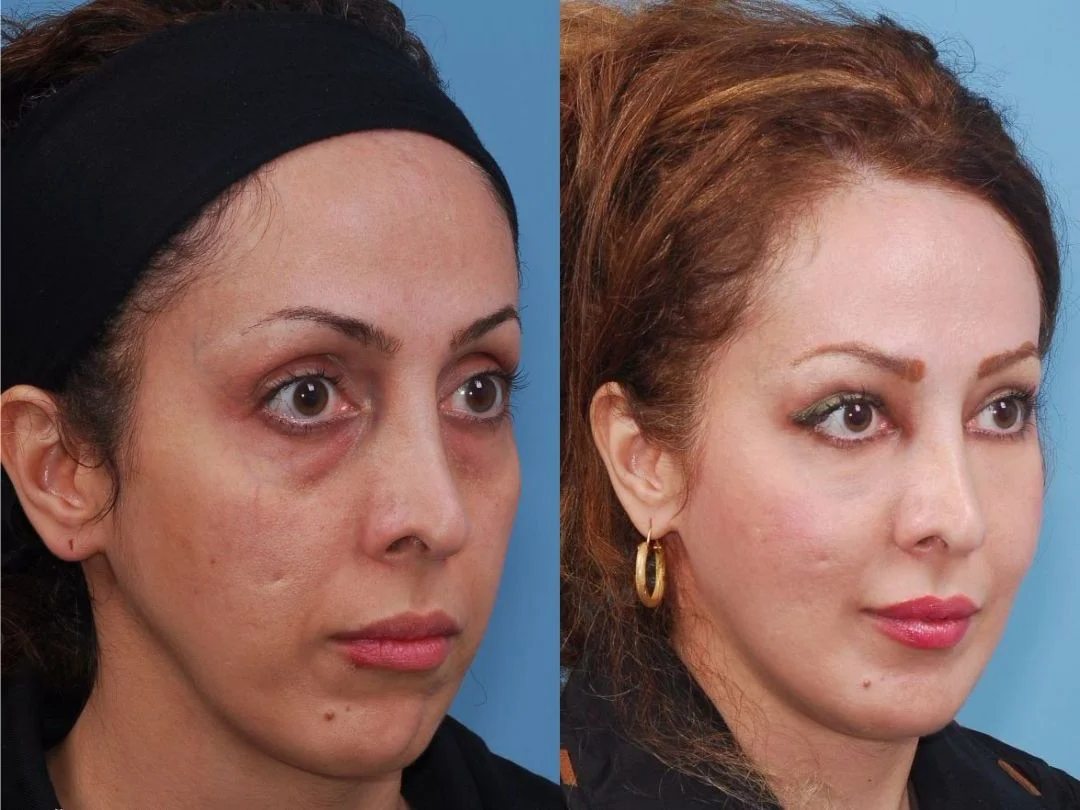 Full Face Fat Transfer: What Really Happens at Blue Angel Polyclinic