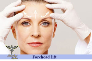 forehead lift