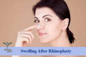 Swelling after rhinoplasty
