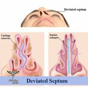 deviated septum