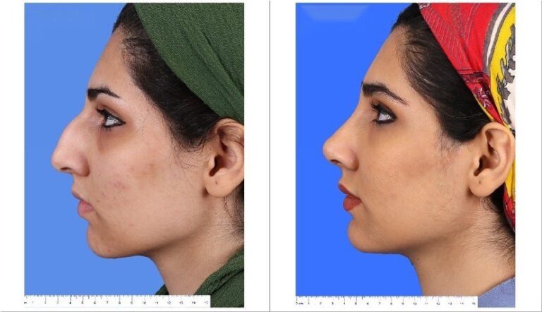 Before & After Nose Job