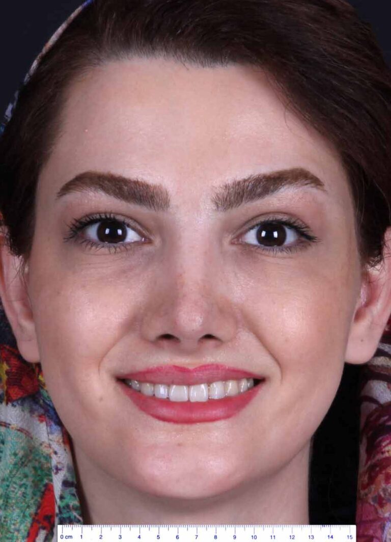 After nose job serguery