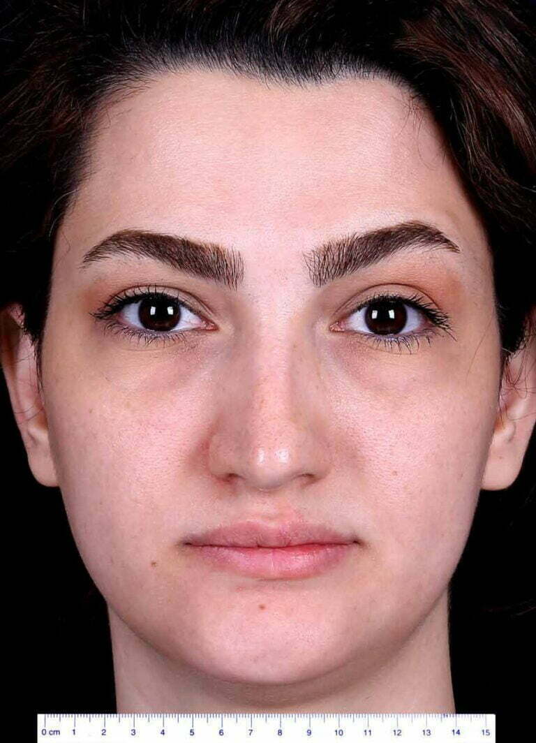 Before nose job seurgery photo