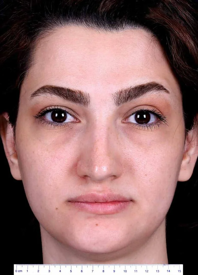 Before nose job seurgery photo