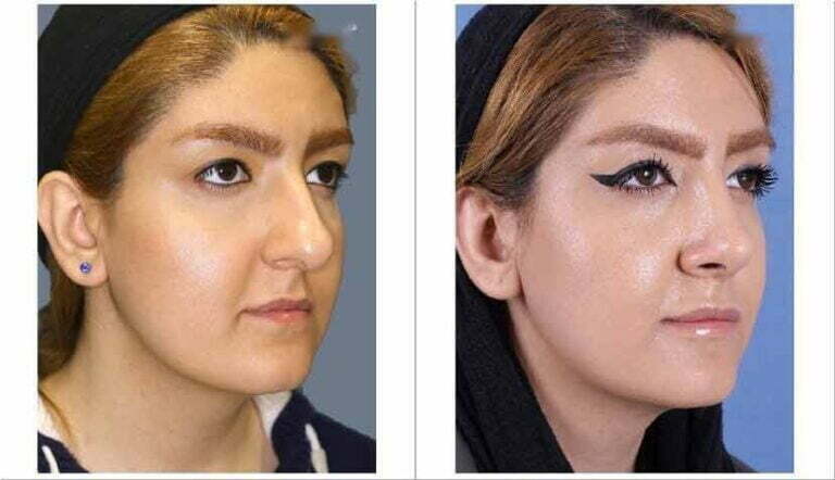 Nose Job Before and After 2