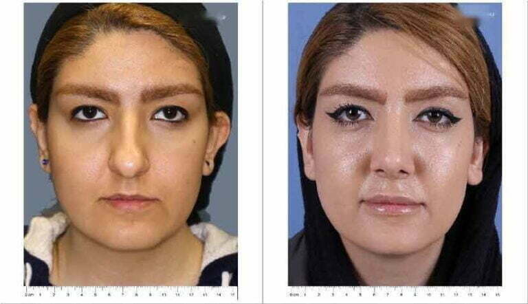 Nose Job Before and After 3