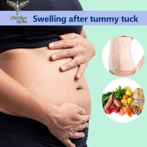 swelling after tummy tuck - Blue Angel Clinic 