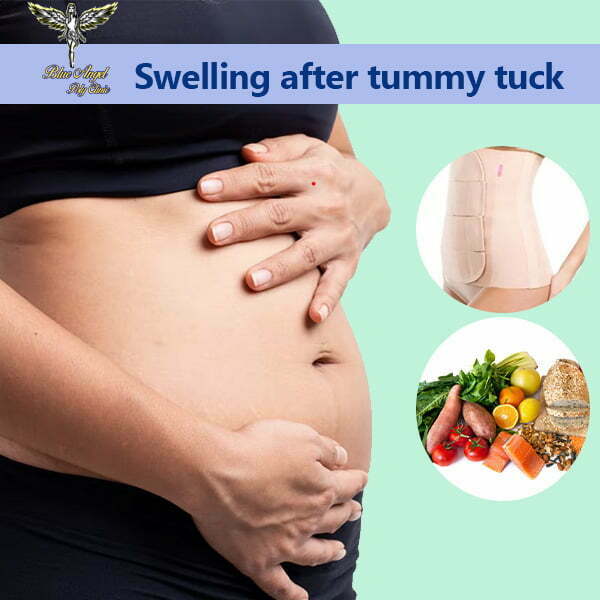 How can reduce swelling after tummy tuck ?