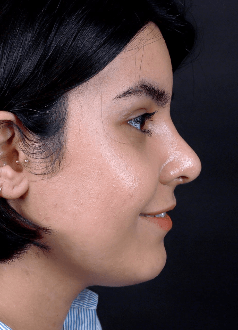 Endoscopic foehead lift