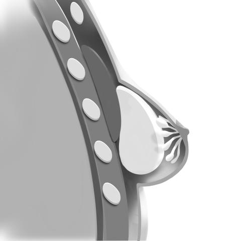 Illustration of breast implant above pectoral muscle