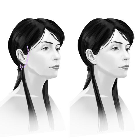 Before and after facelift results