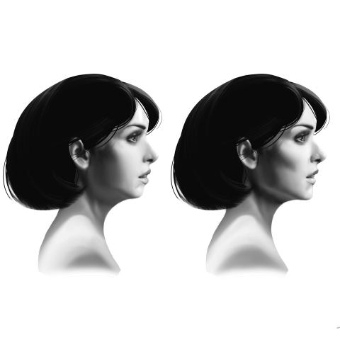 Before and after facial implants