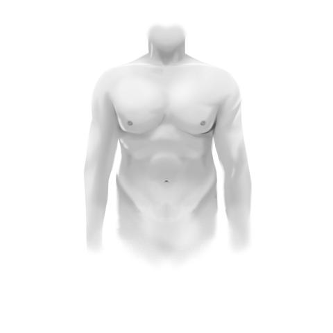After gynecomastia surgery