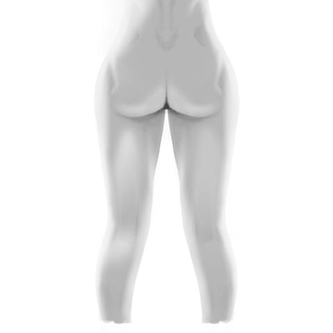 After Liposuction Treatment on Hips and Thighs