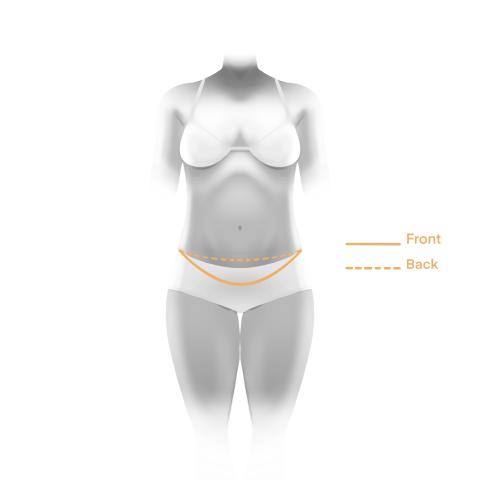 Illustration of front lower body lift incision