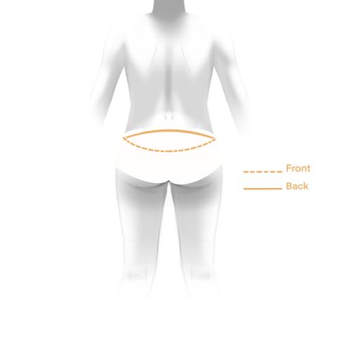 Illustration of back lower body lift incision
