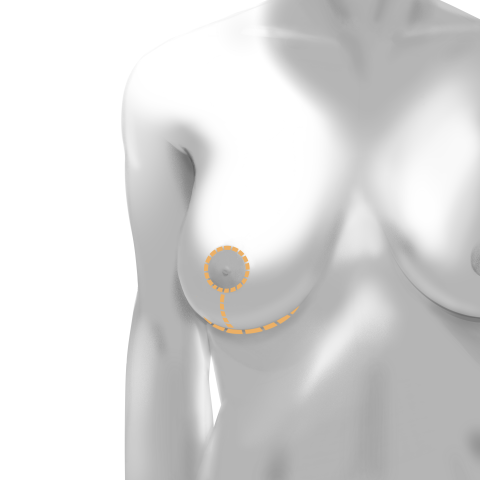 Anchor incision pattern for breast lift