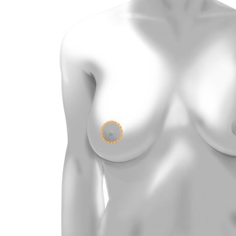 Donut incision for breast lift