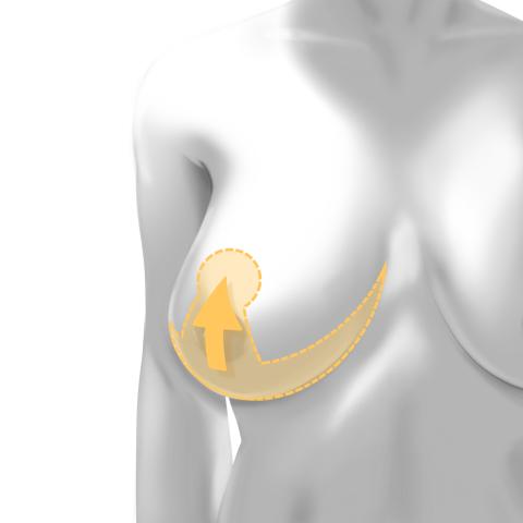 Breast reduction incision patterns