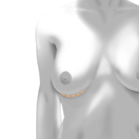 Inframammary incision under the breast