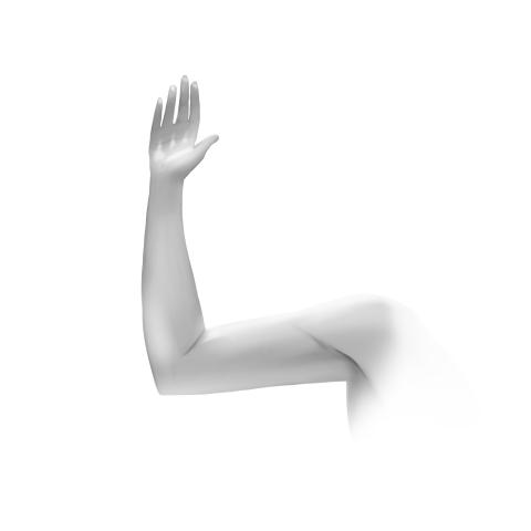 After Upper Arm Lift