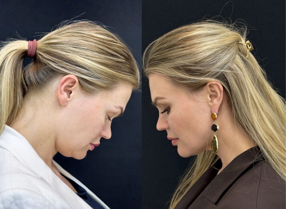 UltraClear Laser treatment in Dubai