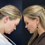 UltraClear Laser treatment in Dubai