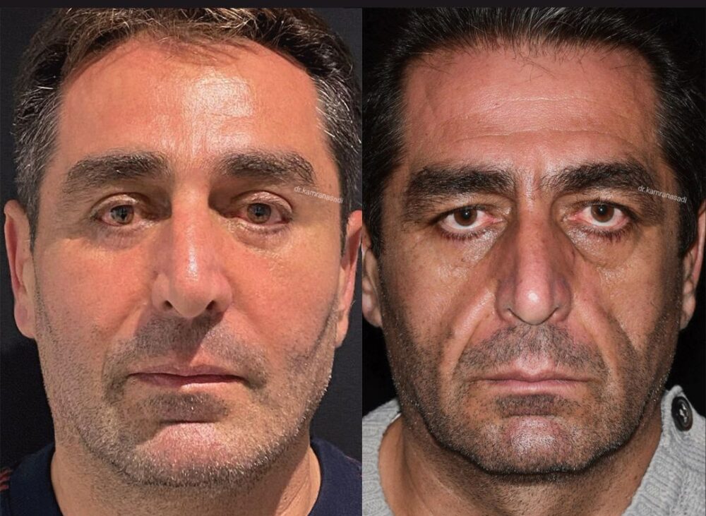 Endoscopic Forehead Lift in Dubai