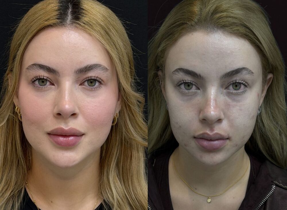 Full Face Fat Transfer in Dubai