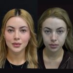 Full Face Fat Transfer in Dubai