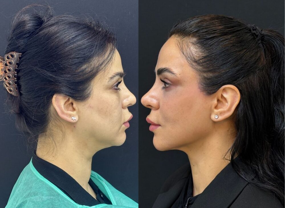 Endolift Laser Treatment in Dubai