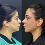 Endolift Laser Treatment in Dubai