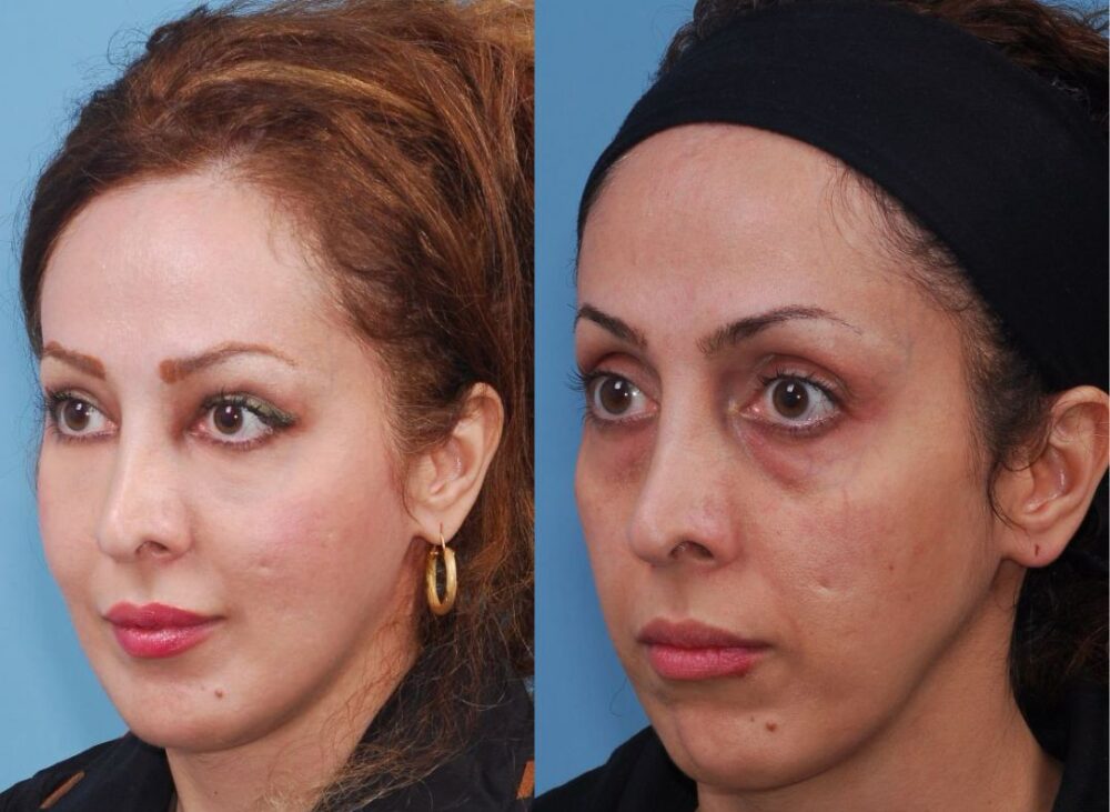 Full Face Fat Transfer in Dubai