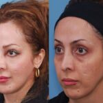 Full Face Fat Transfer in Dubai
