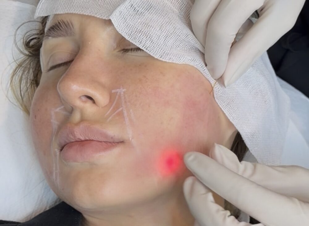Endolift vs Traditional Facelift