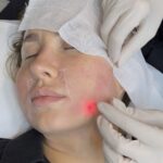 Endolift vs Traditional Facelift