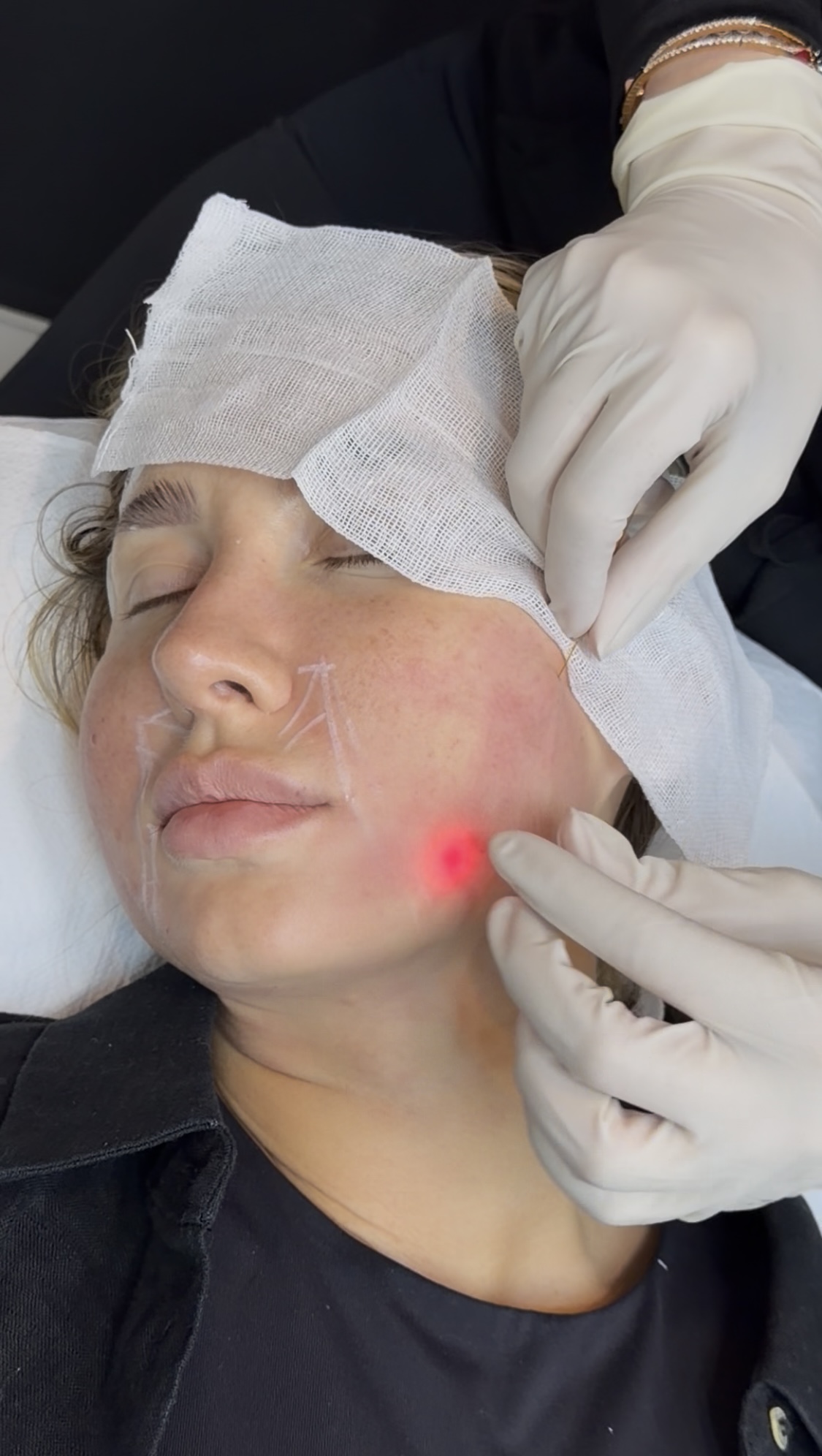 Endolift vs Traditional Facelift