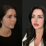 Fat transfer vs dermal fillers comparison for facial rejuvenation, Blue Angel Polyclinic Dubai