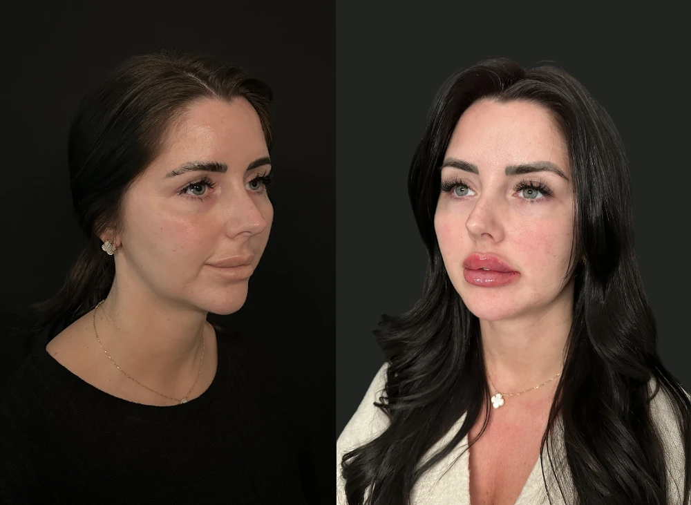 Fat transfer vs dermal fillers comparison for facial rejuvenation, Blue Angel Polyclinic Dubai
