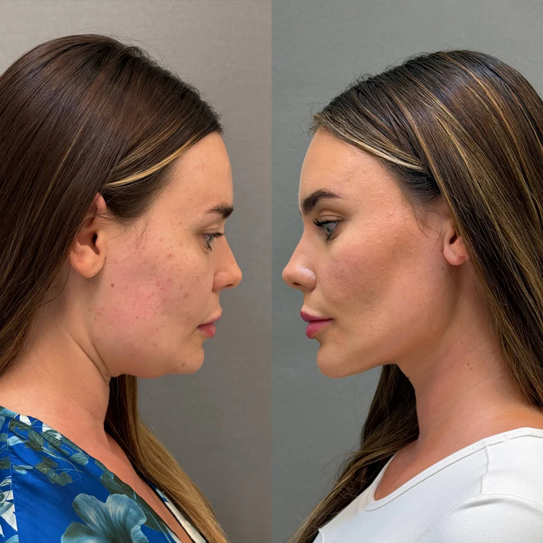 Endolift jawline Dubai