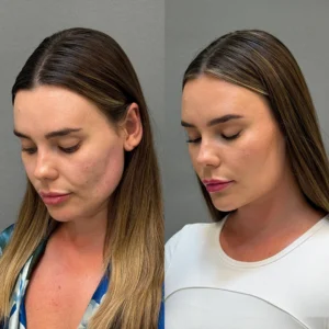 Endolift jawline treatment in Dubai