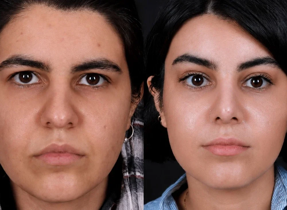 endoscopic vs traditional brow lift